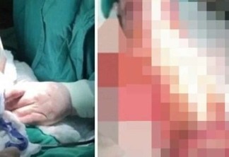 FETICHE VEGETAL: Homem se submete cirurgia após usar mandioca de 45cm como brinquedo sexual