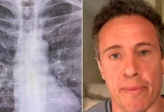 Apresentador da CNN exibe raio-x de pulmão para alertar sobre gravidade da covid-19