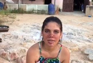 Paraibana sofre com doença que causa nódulos anormais na pele, e família faz campanha para pagar cirurgia: "Ela sofre muito!" - VEJA VÍDEO