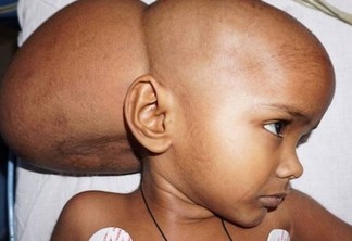 ÊXITO DA MEDICINA: Médicos retiram com sucesso tumor do tamanho de uma bola de futebol de menina