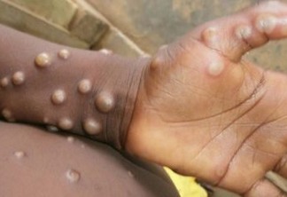 Diferente do coronavírus, varíola dos macacos tem difícil transmissão; saiba mais sobre a doença