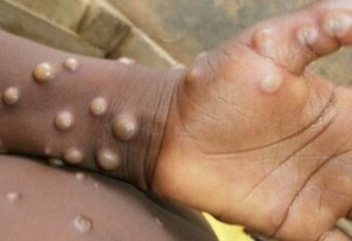 ALERTA! Estudo mostra que varíola dos macacos foi transmitida durante sexo em 95% dos casos