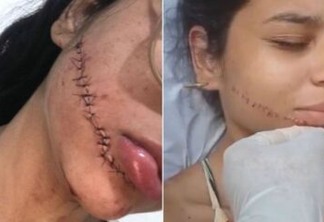 Estudante que levou 18 pontos no rosto após sofrer corte em ônibus faz tratamento para a cicatriz