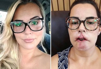 Influenciadora tem lábio danificado após procedimento de harmonização facial com PMMA: "Só conseguia chorar"