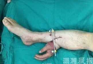 Mão decepada em acidente é implantada em perna de paciente; Entenda