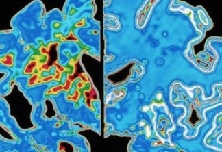 Teste de labirinto virtual promete prever Alzheimer décadas antes de sintomas