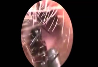 VEJA VÍDEO: Médicos retiram mais de mil formigas que estavam vivendo dentro do ouvido de uma menina de 12 anos