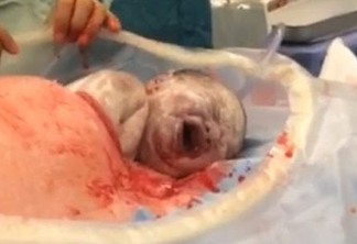 CENAS FORTES - Bebê "rasteja" para sair do útero da mãe durante cesariana e vídeo viraliza