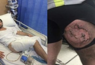 Ciclista tem queimadura na coxa após iPhone6 explodir