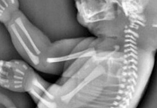 Mulher aborta bebê que teria "síndrome da sereia"