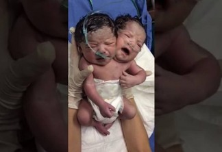 VEJA VÍDEO - Morre bebê que nasceu com duas cabeças, no México