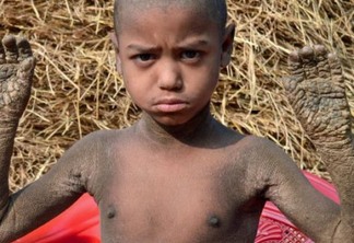 Menino de Bangladesh está se transformando em “pedra” devido à doença rara - VEJA VÍDEO