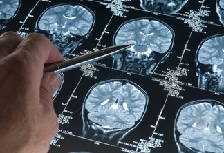 MAIS SAÚDE: Pesquisadores italianos acham verdadeira origem do Alzheimer