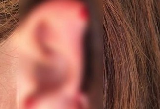 Mulher tem orelha arrancada a dentadas após crise de ciúmes