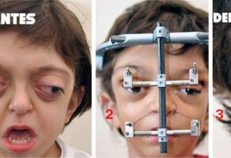 Uma síndrome rara desfigurou seu rosto ao nascer; veja como ele ficou após o tratamento