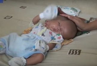 VEJA VÍDEO: Bebê nasce com dois rostos e dois cérebros na Indonésia