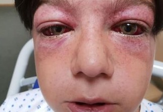 Novo desafio da internet deixa criança de 11 anos gravemente ferida