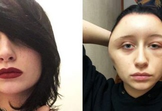 ALERGIA EXTREMA: Jovem decide pintar o cabelo em casa e quase morre após ficar deformada