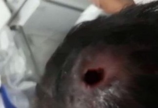 Hospital retira 50 larvas de cabeça de menina de 10 anos