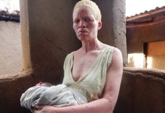 'Tenho medo de dormir': a cruel caçada por ossos de albinos no Malauí