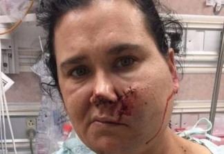 Mulher fica com flecha cravada no rosto ao salvar filho durante briga