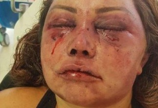 Reconstrução de rosto de mulher espancada vai durar seis meses, diz médico
