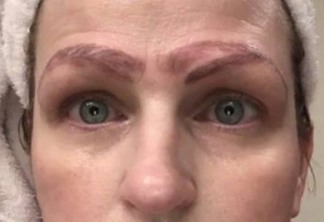 Mulher fica com quatro sobrancelhas após procedimento estético desastroso