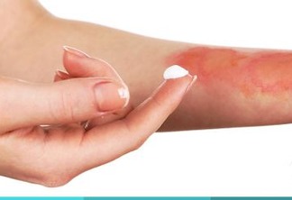 Substâncias inadequadas em queimaduras podem agravar o dano causado à pele, afirma dermatologista