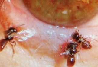 Médicos tiram 4 abelhas vivas de dentro do olho de uma mulher