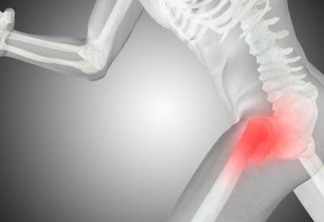 Osteoporose atinge 10 milhões de brasileiros e diagnóstico precoce é essencial para combater a doença, afirma ortopedista