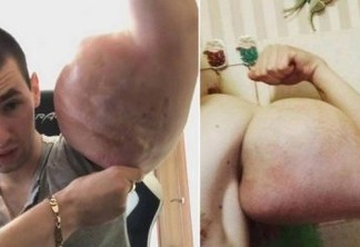 'Popeye russo' faz apelo por cirurgia para salvar os braços 'deformados'