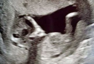 Pais de bebê ficam chocados ao ver forma estranha em ultrassom
