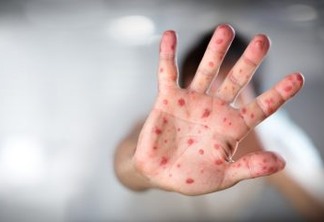 Viral Diseases - Hand Infected - Hand foot and mouth disease HFMD