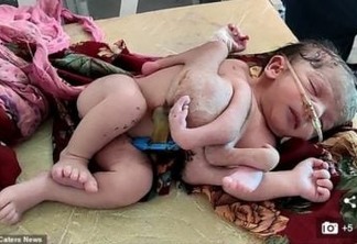 Bebê nasce com três mãos e quatro pernas devido má formação no útero