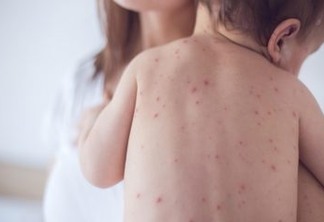 Paraíba tem 3 casos confirmados de sarampo e infectologista alerta para sintomas e orienta sobre importância da vacina