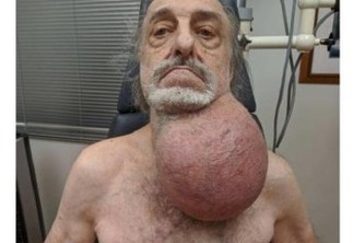 TINHA 3 QUILOS: Homem tira tumor do tamanho de uma bola de futebol do pescoço