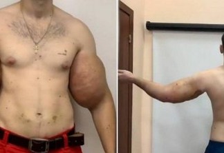 'Popeye' russo tem 1,5 quilo de 'músculo morto' removido de braço