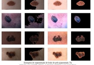 Câncer de pele: Câmera de celular pode identificar 99% dos casos
