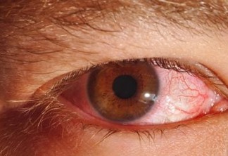 Homem descobre caso raro de sífilis nos olhos após ir ao médico por conta de dor de cabeça