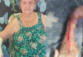 Idosa tem braço cortado ao retirar gesso em hospital: 'chorava de dor'