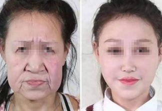Adolescente de 15 anos com envelhecimento precoce ganha novo rosto em cirurgia