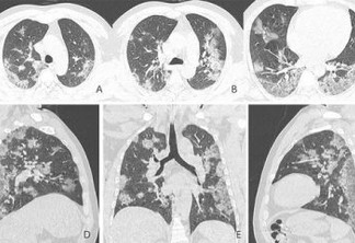 CORONAVÍRUS: Pacientes recuperados podem ter danos permanentes nos pulmões