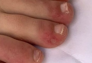CORONAVÍRUS: "Dedos de COVID" pode ser um dos mais novos sintomas da doença