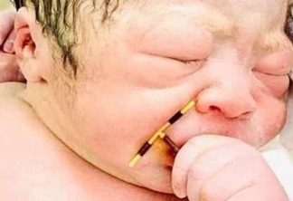 Bebê nasce agarrado ao DIU que mãe tinha colocado e foto viraliza