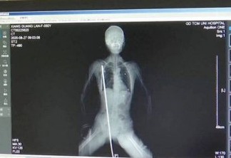 Mulher sobrevive após barra de aço de quase 1 metro atravessar seu corpo