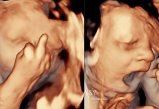 Bebê choca pais ao mostrar 'dedo do meio' e bocejar em ultrassom