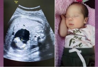 Bebê nasce "grávida" na Colômbia