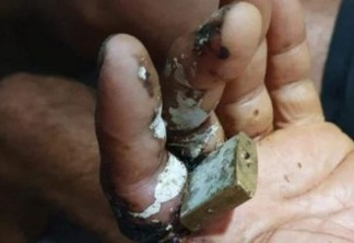 Bombeiros socorrem homem com cadeado preso no dedo por oito dias