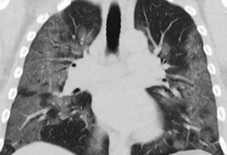 Paciente transplantada morre de Covid-19 após receber pulmões infectados