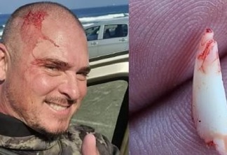 Pescador subaquático remove dente de tubarão da cabeça após ataque - VEJA VÍDEO